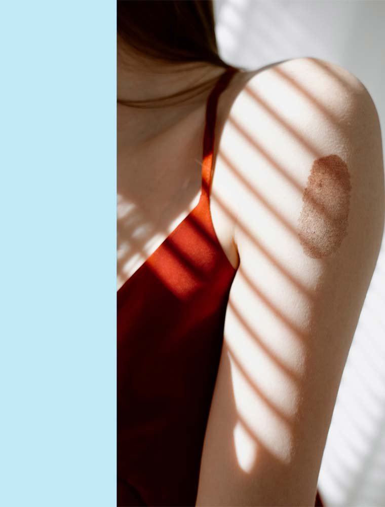 Birthmark Reduction