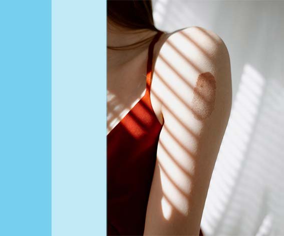 Birthmark Reduction