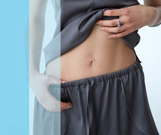 Stretch Marks Reduction